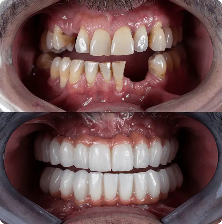 Full mouth dental implant transformation — before and after