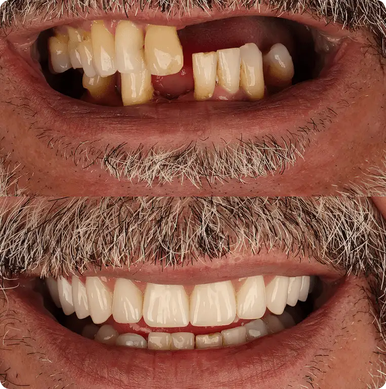 Front tooth implant — before and after