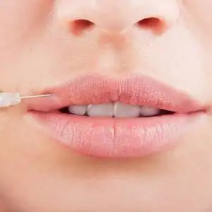 Lip Enhancement at Stunning Skin Clinic, Ealing