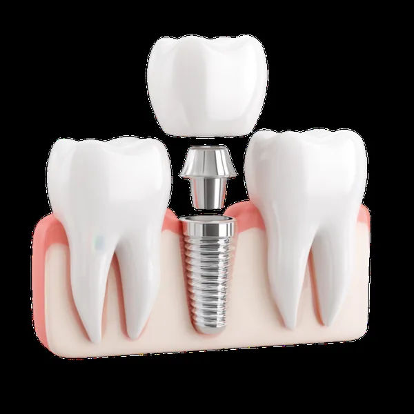Dental Implants in Ealing — From £1,950 with Final Crown at Stunning Smile Clinic, Ealing