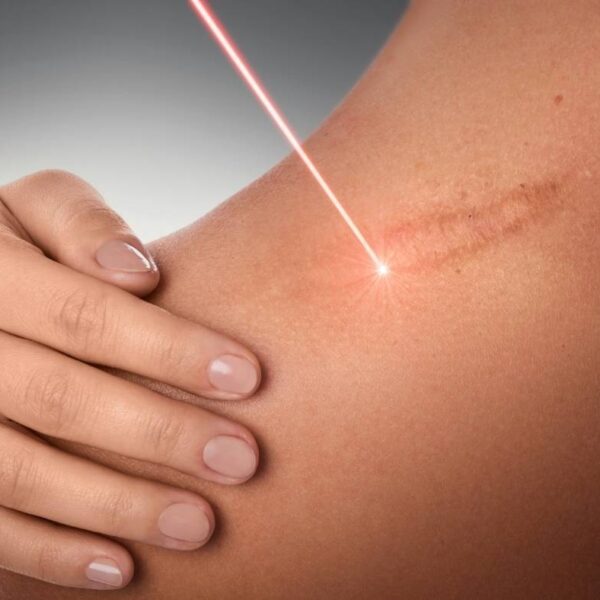 Scar Treatments