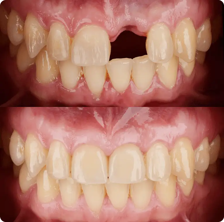 Missing front tooth replaced with implant — before and after