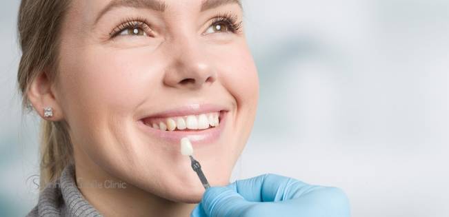 Close-up of a patient with dental veneers in Ealing, showcasing a bright and natural-looking smile.