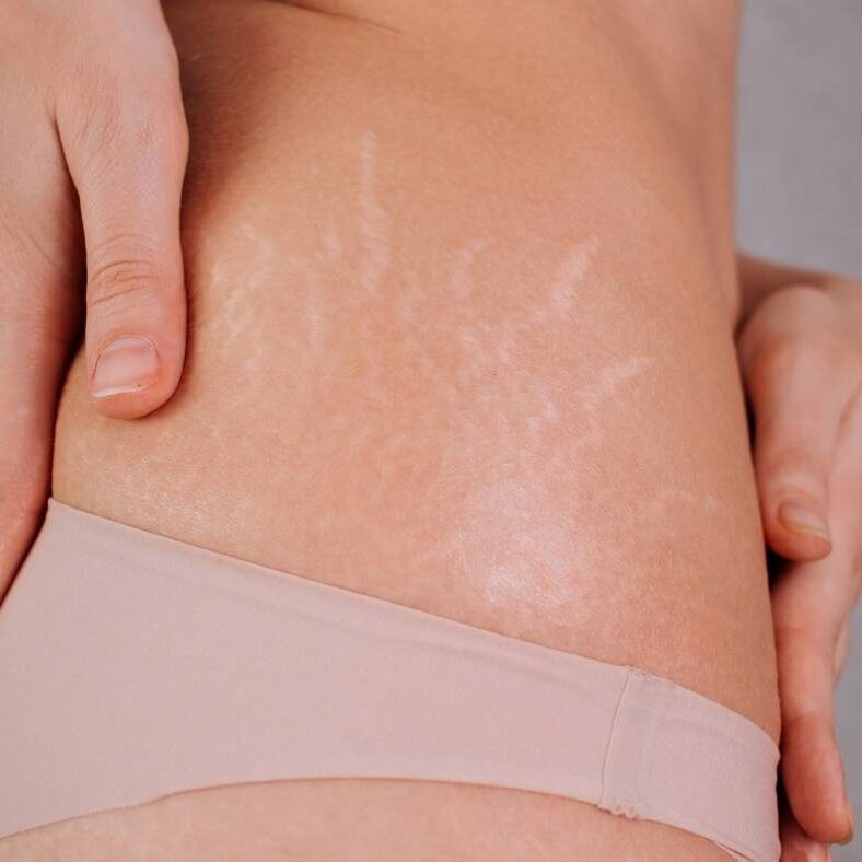 Stretch Marks Removal Treatment