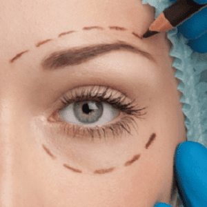 Non Surgical Eyelid Correction