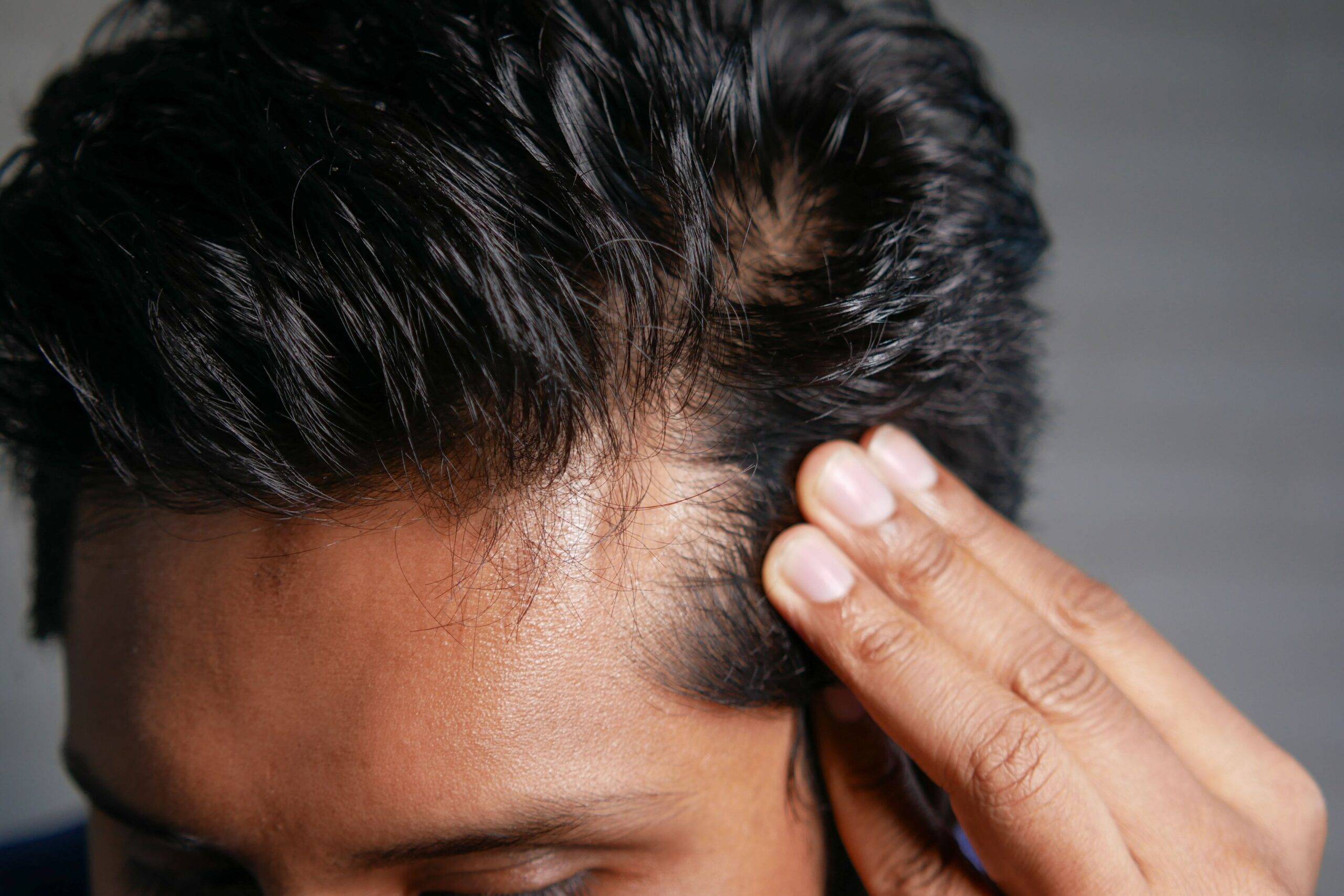 PRP therapy in Ealing at Stunning Skin Clinic