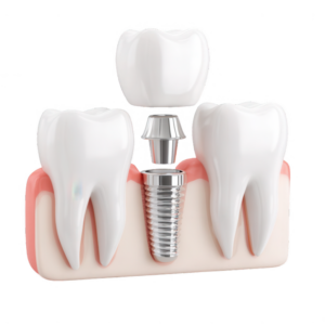Single Tooth Implant in Ealing