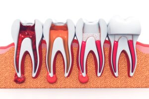 Root canal retreatment