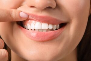 CEREC Same-Day Restorations