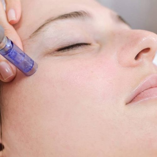 Micro needling